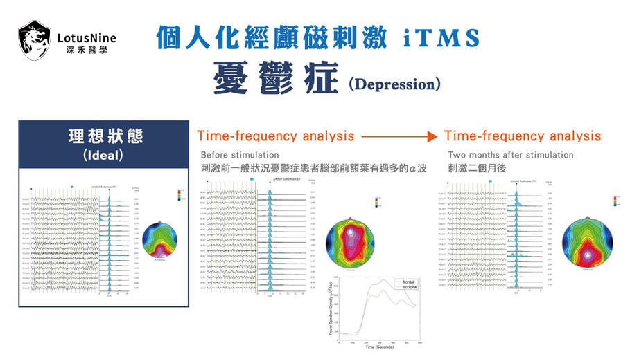 療程前後腦波時頻分析比較圖（衛教示意）